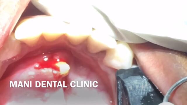 Salivary stone removal