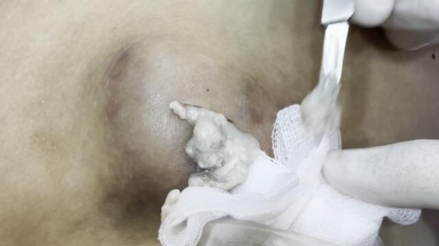 無盡的粉瘤+囊袋切除 美麗新城診所莊禮謙醫師 Endless Squeezing, Cyst, Dr George