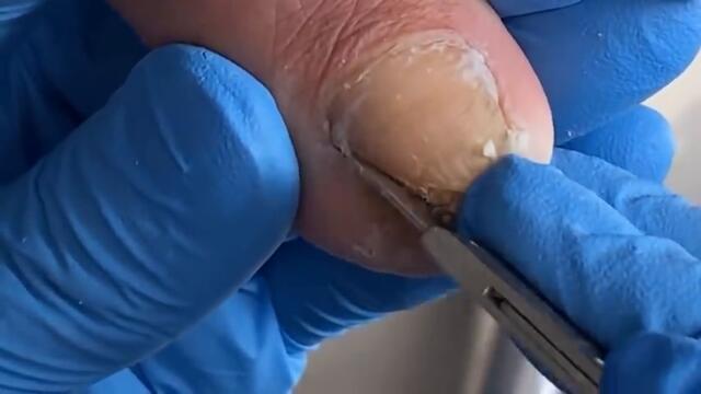The inside of the toenail is in bad condition, full of dead skin and dirt【Xue Yidao】