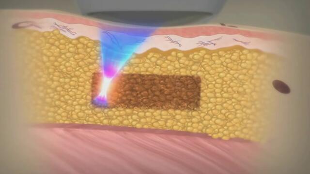 Липосоникс терапияvia torchbrowser.com - Vbox7[via torchbrowser.com]