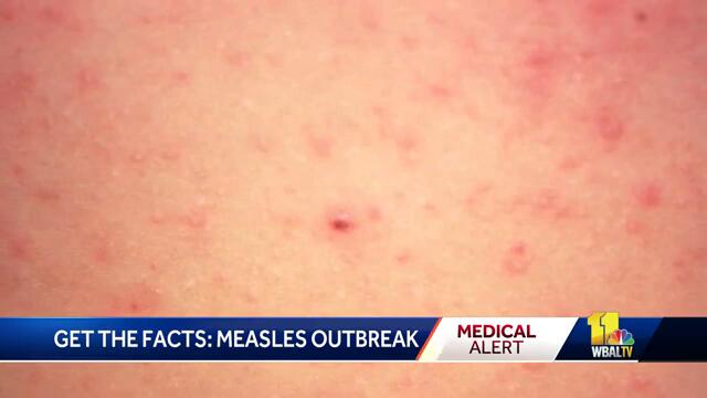 Expert: Vaccine prevents measles, not alternative treatments